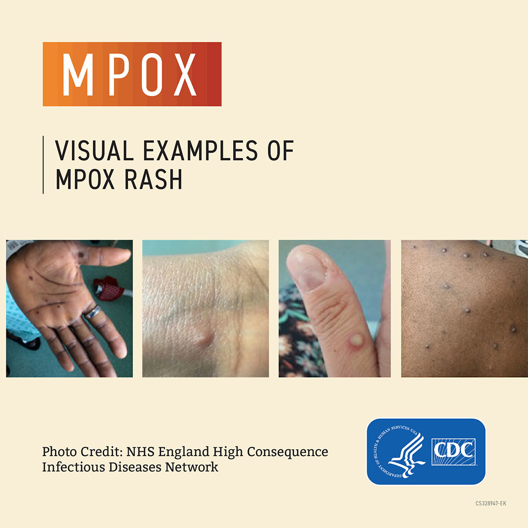 Mpox